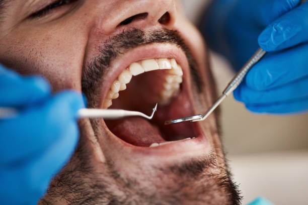 Best Emergency Dentist for Lost Fillings or Crowns in Rantoul, IL